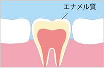 進行段階1　C0：ごく初期の虫歯