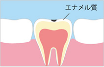 進行段階2　C1：初期の虫歯