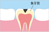 進行段階3　C2：虫歯の中期