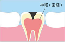 進行段階4　C03：虫歯の後期