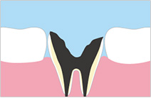 進行段階5　C04：虫歯の末期